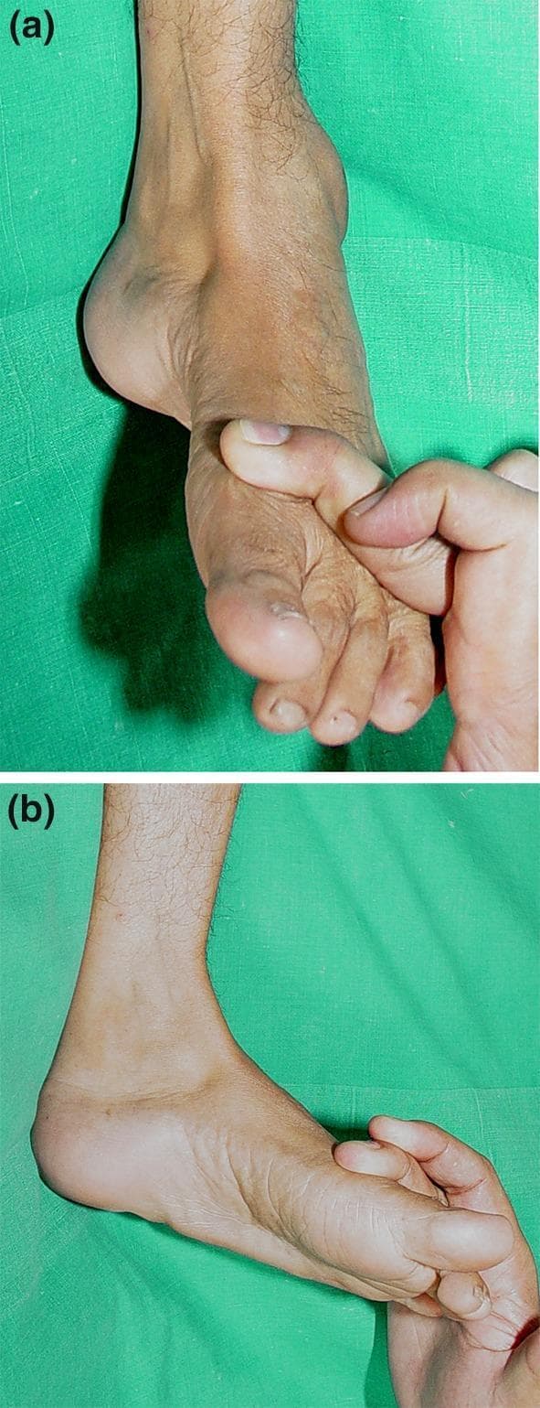 This composite clinical photograph demonstrates manual muscle testing (MMT) of the foot and ankle, typically performed to assess neurological or musculoskeletal impairment, such as in post-polio sequelae. Image (a) depicts the assessment of ankle dorsiflexor power. The clinician's hand applies downward resistance against the dorsal aspect of the forefoot and toes while the patient attempts to lift the foot, testing the tibialis anterior and extensor muscles. The foot shows a slight cavus arch. Image (b) demonstrates the testing of the foot invertors (primarily the tibialis posterior). The examiner applies lateral and eversional force against the medial border of the forefoot while the patient attempts to pull the foot inward (inversion). These clinical maneuvers are essential for grading muscle strength according to the Medical Research Council (MRC) scale, particularly when planning surgical interventions like tendon transfers or stabilizing arthrodesis to correct deformities such as equinovarus or calcaneocavovalgus.
