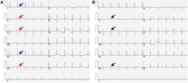 Comparison of two 12-lead electrocardiograms (ECG) demonstrating the temporal evolution of an inferior myocardial infarction. Panel A shows the acute phase on admission, characterized by significant ST-segment elevation (STEMI) in inferior leads II, III, and aVF (indicated by red arrows). This is accompanied by reciprocal ST-segment depression in high lateral leads I and aVL (indicated by blue arrows), which is a classic diagnostic marker for acute inferior wall ischemia. Panel B displays the ECG one week post-admission following intervention. Key morphological changes include the resolution of ST-segment elevations toward the baseline and the development of pathological Q waves in the inferior leads (indicated by black arrows). The appearance of these Q waves represents the transition from acute injury to established myocardial necrosis/scarring. This side-by-side comparison illustrates the typical electrocardiographic progression from hyperacute ST-segment elevation to the chronic development of Q-wave infarction in the inferior territory of the heart.