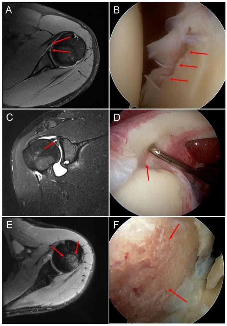 This composite educational image provides a side-by-side comparison of magnetic resonance (MR) and arthroscopic imaging for common shoulder pathologies resulting from anterior traumatic shoulder dislocation. (A, B) A Bankart lesion: the axial MR image shows an anterior-inferior labral tear, while the corresponding arthroscopic view shows direct visualization of the detached and frayed ventral labrum. (C, D) Superior Labrum Anterior to Posterior (SLAP) lesion: the MR arthrogram displays high signal intensity in the superior labrum, while the intraoperative image reveals a physical tear at the biceps tendon anchor point, being evaluated with a probe. (E, F) Hill-Sachs lesion: the axial MR image demonstrates a compression fracture of the posterolateral humeral head (bony defect), which is visualized arthroscopically as an area of eroded cartilage and subchondral bone with a coarse, uneven texture. These panels highlight the correlation between radiological findings and direct surgical visualization in orthopedic surgery, specifically focusing on glenohumeral instability and intra-articular damage.