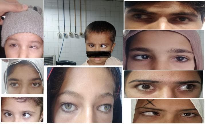 A collage of clinical photographs showcasing various manifestations of strabismus (squint) in pediatric and adult patients. The images demonstrate different types of ocular misalignment, including esotropia (inward deviation of one eye) and exotropia (outward deviation of one eye) relative to the fixating eye. Several frames highlight the asymmetry in pupillary alignment and the visible corneal light reflex displacement, which are key diagnostic signs. The collection illustrates clinical variations in the degree of deviation, ranging from subtle misalignment to more pronounced, large-angle strabismus. These visual findings are frequently associated with amblyopia (lazy eye), where the brain favors the visual input from the correctly aligned eye. The clinical relevance of this visual resource is in ophthalmology and optometry education, specifically for identifying sensory and motor ocular abnormalities and understanding the visual presentation of binocular vision disorders.