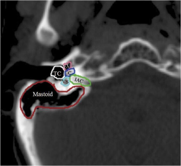 This diagnostic image is an axial Computed Tomography (CT) scan of the temporal bone, showcasing the detailed anatomy of the human auditory apparatus with color-coded contours. The visual demonstrates the spatial relationships between key middle and inner ear structures. The Eustachian tube (ET) is contoured in pink, positioned anteriorly. The tympanic cavity (TC), representing the air-filled middle ear space, is outlined in white. Posterior to these lies the inner ear complex, including the coiled cochlea (C) in blue and the vestibular apparatus (VS) in light blue. The internal auditory canal (IAC), which transmits the vestibulocochlear and facial nerves, is highlighted in green extending medially. Occupying the posterior and lateral aspect is the mastoid antrum and air cell system (Mastoid), outlined in red. This anatomical diagram serves as an educational tool for identifying critical landmarks in otology and radiology, often utilized for pre-operative planning or assessing radiation dose distribution in oncological treatments involving the head and neck.