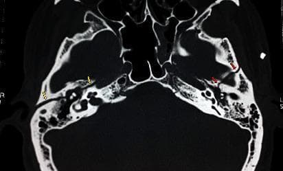 This diagnostic image is a high-resolution axial computerized tomography (CT) scan of the skull base, specifically focusing on the temporal bones at the level of the incudomalleolar joint. The image demonstrates bilateral temporal bone fractures with different orientations. On the patient's right side, yellow arrows indicate a longitudinal temporal bone fracture that appears to be otic-sparing, running parallel to the long axis of the petrous pyramid. On the patient's left side, red arrows highlight a transverse temporal bone fracture, which crosses the petrous ridge perpendicularly. Key anatomical structures visible include the mastoid air cells, the sphenoid bone, and the ossicular chain (incus and malleus) within the middle ear cavity. This scan is educationally significant for distinguishing between longitudinal and transverse fracture patterns and their respective proximity to middle ear structures, which is critical in evaluating trauma-related hearing loss and facial nerve paralysis.