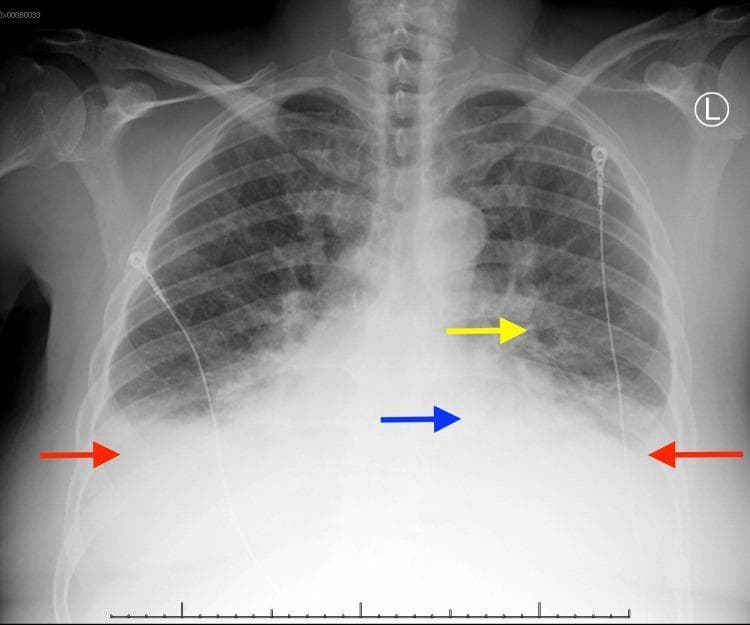 This diagnostic image is an anteroposterior (AP) chest x-ray demonstrating clinical features of congestive heart failure and pulmonary edema. The image is annotated with colored arrows to highlight key findings: cardiomegaly is indicated by an enlarged cardiac silhouette (blue arrow); bilateral pleural effusions are visible as increased basal opacities with blunting of the costophrenic angles (red arrows); and pulmonary vascular congestion is shown through increased prominence and blurring of the hilar and pulmonary vessels (yellow arrow). Diffuse bilateral pulmonary opacities are present throughout the lung fields, consistent with alveolar edema. Radiopaque ECG leads are visible across the thoracic surface, and a radiopaque tube or catheter is seen descending along the right side of the patient. The skeletal structures, including the ribs and clavicles, are visible. This visual serves as an educational example of the radiological manifestations of cardiogenic shock and reduced ejection fraction.