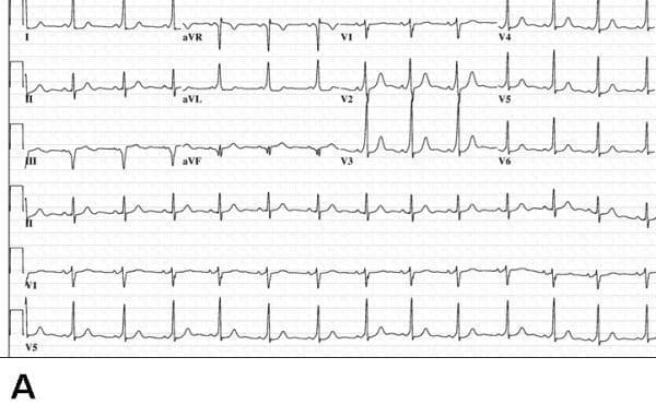 This diagnostic image shows a standard 12-lead electrocardiogram (ECG) labeled as Panel A, demonstrating features of manifest ventricular preexcitation characteristic of Wolff-Parkinson-White (WPW) syndrome. Key visual findings include a shortened PR interval and the presence of a delta wave, visible as a slurred upstroke at the beginning of the QRS complex. The delta wave is notably positive in lead I and negative in lead aVF, suggesting a specific bypass tract orientation. In the precordial leads, lead V1 displays a predominant S wave (S > R), which is a characteristic morphology often associated with a right-sided or posteroseptal accessory pathway location. The QRS complex is slightly widened due to the preexcitation. The rhythm is sinus, and the image serves as an educational example for identifying the ECG signature of accessory conduction pathways before therapeutic intervention.