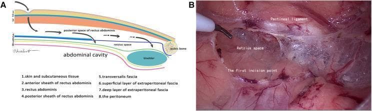 This composite educational material consists of an anatomical diagram (A) and a corresponding intraoperative clinical photograph (B) illustrating the surgical approach to the preperitoneal space during hernia repair. Diagram A provides a sagittal cross-section of the abdominal wall layers, including the skin, rectus abdominis, posterior rectus sheath, transversalis fascia, and peritoneum, highlighting the entry pathway into the Retzius space above the bladder and pubic bone. Intraoperative image B shows the laparoscopic view of the 'first incision point' within the transversalis fascia, located approximately 1 cm above the pectineal ligament (Cooper's ligament). The Retzius space is visible as a cavitary area with glistening, translucent connective tissue and fibrous networks. The pectineal ligament is identified as a distinct whitish band at the superior margin. This visual material is designed for surgical trainees to understand the 'transversalis fascia reference plane' and membrane anatomy during Totally Extraperitoneal (TEP) laparoscopic hernia repair, emphasizing safe entry into the Retzius space to avoid vascular or bladder injury.