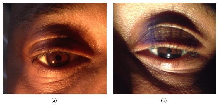 This clinical photograph consists of two side-by-side images (a and b) demonstrating the classic ophthalmic manifestations of Horner's syndrome. Image (a) shows a normal right eye with a typical upper eyelid position, palpebral fissure width, and pupil diameter. Image (b) displays the affected left eye, exhibiting a triad of clinical findings: ptosis (drooping of the upper eyelid), miosis (a constricted pupil compared to the contralateral side), and apparent enophthalmos (the appearance of a sunken globe within the orbit). The narrowing of the palpebral fissure is clearly visible in the left eye due to the superior eyelid malposition. This visual comparison is a definitive educational tool for identifying sympathetic pathway disruption, often associated with neurological or paraspinal pathology such as Pancoast tumors or leukemic infiltration (chloroma). The images are intended for intermediate to advanced medical learners focusing on neurology, ophthalmology, or oncology.