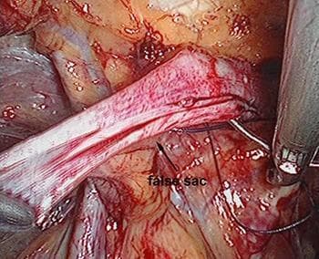 This clinical photograph captures an intraoperative endoscopic view during a Totally Extraperitoneal (TEP) inguinal hernia repair. The central focus is the 'false sac,' identified as a tubular, fibrous structure with a striated, whitish-red texture, indicating vascularization of the peritoneal tissue. A curved surgical suture needle is shown penetrating the base of this sac to secure it to the conjoined tendon or pectineal ligament. Metallic laparoscopic instruments, including grasping forceps, are visible on the periphery, manipulating the surrounding preperitoneal adipose and connective tissues. The image demonstrates the surgical technique of internal ring suturing to reduce the defect size before mesh placement. Key educational concepts include the identification of hernia sac morphology, management of the preperitoneal space, and laparoscopic suturing techniques in abdominal wall reconstruction. The clinical relevance pertains to surgical anatomy and the prevention of hernia recurrence through mechanical reinforcement of the internal ring.