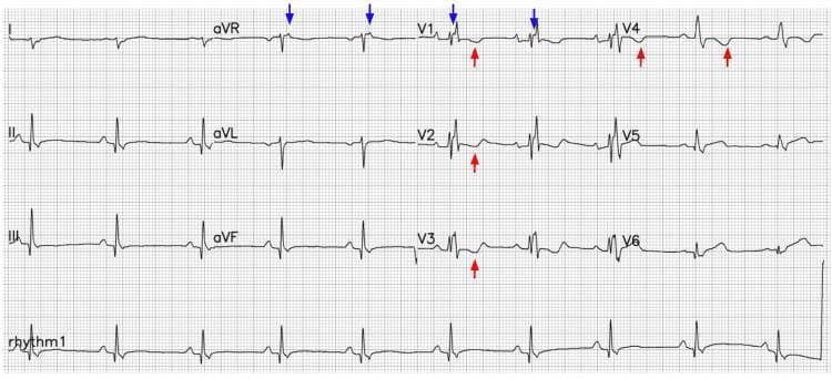 A 12-lead electrocardiogram (ECG) demonstrating key diagnostic features of Arrhythmogenic Right Ventricular Cardiomyopathy (ARVC). The tracing shows a sinus rhythm with a widened QRS complex and a morphology consistent with a Right Bundle Branch Block (RBBB). Blue arrows indicate the presence of Epsilon waves, characterized by low-amplitude positive deflections at the terminal end of the QRS complex, specifically visible in leads aVR and V1. Red arrows highlight deep, symmetrical T-wave inversions (TWI) across the precordial leads V1 through V4. These findings represent classic depolarization and repolarization abnormalities associated with ARVC. The image serves as a high-yield educational resource for cardiology and emergency medicine, illustrating the specific ECG criteria used for the diagnosis of right ventricular structural heart disease and the assessment of sudden cardiac death (SCD) risk factors in young adults.