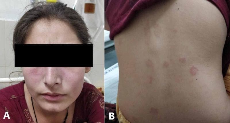 Two-panel clinical photograph illustrating dermatological manifestations of systemic lupus erythematosus (SLE) in a 20-year-old female. Image A presents a frontal view of the patient's face showing a classic malar or 'butterfly' rash. This is characterized by symmetric, erythematous, non-blanching patches across the malar eminences (cheeks) and bridge of the nose. Notably, there is distinct nasolabial sparing, a hallmark feature that differentiates this from other facial dermatoses like seborrheic dermatitis. Image B displays the patient's posterior trunk (back), exhibiting multiple discrete, erythematous, circular to oval maculopapular lesions. These lesions are scattered across the upper back and flank areas, appearing as distinct spots against otherwise clear skin, in contrast to the diffuse confluent redness on the face. These clinical findings are visually representative of acute cutaneous lupus erythematosus flares. The presentation is contextually associated with multisystem involvement, including pericarditis and hematologic abnormalities.