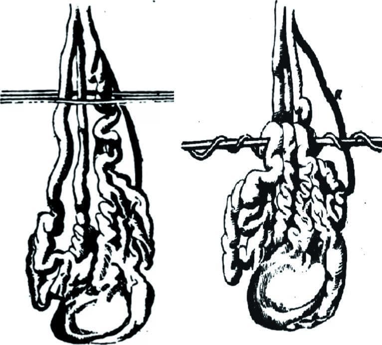 This historical medical illustration depicts 'Vidal's technique' (Vidal de Cassis), an early surgical procedure for the treatment of varicocele. The diagram shows the male reproductive anatomy, specifically the pampiniform plexus and scrotal sac. The visual is divided into two parts illustrating the progression of the technique. Elongated, tortuous varicose veins are shown suspended within the scrotum. A horizontal iron pin is passed behind the venous cluster, while silver wires are passed in front of them. The second part of the diagram demonstrates the mechanical objective of the procedure: the wire is progressively twisted around the pin to compress the dilated veins. This historical approach sought to cause the ulceration and subsequent obliteration of the varicoceles through pressure-induced necrosis and inflammatory adhesion. The illustration serves as a comparative reference for the evolution of urological surgery, highlighting the shift from traumatic mechanical compression to modern microsurgical varicocelectomy and ligation techniques.