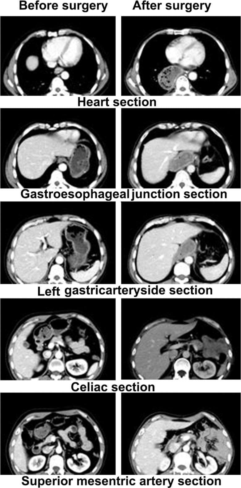 This diagnostic image comprises a series of axial contrast-enhanced CT scans comparing anatomical structures before and after radical surgery for esophageal cancer. The images are organized into five anatomical levels: the heart section, gastroesophageal junction section, left gastric artery side section, celiac section, and superior mesenteric artery section. The 'before surgery' column displays normal mediastinal and upper abdominal anatomy, including the esophagus and stomach in their typical positions. The 'after surgery' column demonstrates significant postoperative anatomical remodeling of the inferior mediastinum and epigastrium. Key changes include the transposition of a gastric conduit into the mediastinum (pull-up), causing a shift in heart and lung position at the thoracic level. At the abdominal levels, there is a notable loss of definition and displacement of vascular landmarks, such as the celiac artery and superior mesenteric artery, often obscured by transposed gastrointestinal tissue. These images illustrate the challenges in postoperative radiotherapy planning, as surgical distortion can shift high-risk lymph node stations (e.g., para-aortic and celiac groups) relative to their preoperative anatomical markers.