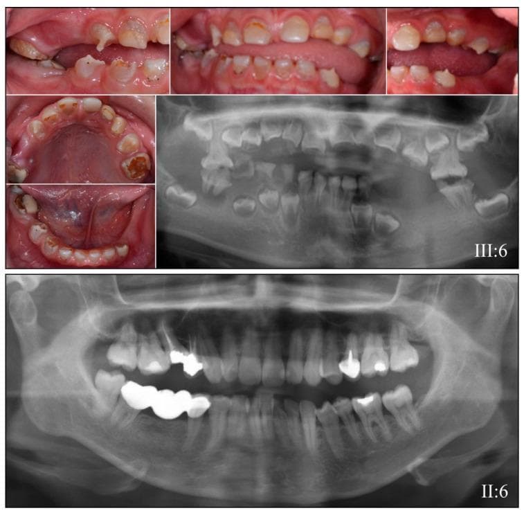 This composite educational image illustrates the clinical and radiographic features of Dentinogenesis Imperfecta (DGI) and Dentin Dysplasia (DD) in a pediatric patient compared to an unaffected adult. The upper section consists of clinical intraoral photographs of an 8-year-old in the mixed dentition stage. The teeth demonstrate characteristic amber-brown opalescent discoloration, bulbous crowns, and severe occlusal attrition leading to enamel loss and dentin exposure. Accompanying these photos is a panoramic radiograph (labeled III:6) showing diagnostic hallmarks including short, tapered roots and partial to complete obliteration of pulp chambers and root canals in both primary and permanent teeth. In contrast, the bottom section displays a panoramic radiograph of an unaffected adult (labeled II:6), showing normal dental morphology with well-defined pulp chambers, standard root lengths, and evidence of routine dental restorations. The comparison highlights the significant structural and developmental abnormalities associated with DSPP gene mutations, emphasizing the diagnostic importance of radiographic pulp obliteration and clinical crown discoloration in hereditary dentin defects.