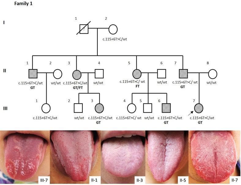 This medical visual combines a three-generation pedigree chart and clinical photographs depicting the inheritance and phenotypic expression of Geographic Tongue (GT) and Fissured Tongue (FT) in a Chinese Han family. The pedigree illustrates an autosomal dominant inheritance pattern associated with the IL36RN mutation (c.115+6T>C). Symbols are used to categorize severity: filled symbols indicate severe GT/FT, cross-hatched symbols indicate mild presentations, and open symbols denote clinical absence. The clinical photographs show phenotypic variability among five family members (III-7, II-1, II-3, II-5, II-7). Key visible features include: (III-7) severe geographic tongue with erythematous patches, white borders, and deep fissures; (II-5 and II-7) prominent midline longitudinal fissures and irregular lateral grooves; and (II-1 and II-3) milder forms of fissuring and varying degrees of lingual papillae atrophy. The composite demonstrates the clinical spectrum of 'GT alone'—a localized manifestation of IL-36 receptor antagonist deficiency—highlighting the correlation between IL36RN genotypes and tongue pathology.