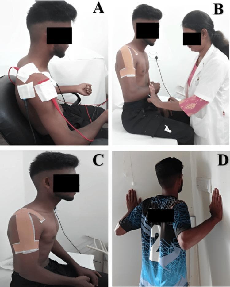 A multi-panel clinical photograph illustrating various stages of physiotherapy and rehabilitation for a shoulder injury. Panel A shows a seated patient receiving interferential therapy (IFT), with a four-pole electrode configuration using large white pads and red/black wires over the right shoulder and periscapular region for pain modulation. Panel B depicts a healthcare professional assisting the patient with isometric external rotation exercises; the patient's shoulder is stabilized with kinesiotherapy tape. Panel C focuses on specialized therapeutic taping, demonstrating an 'inverted J' application over the lateral and anterior deltoid aimed at increasing subacromial space. Panel D shows the patient performing active rehabilitation through wall push-ups in the scaption plane to improve scapular stability and muscle strength. The sequence represents a comprehensive orthopedic rehabilitation protocol ranging from passive pain management to active functional strengthening. The patient is a young adult male, and the setting is a clinical physiotherapy environment.