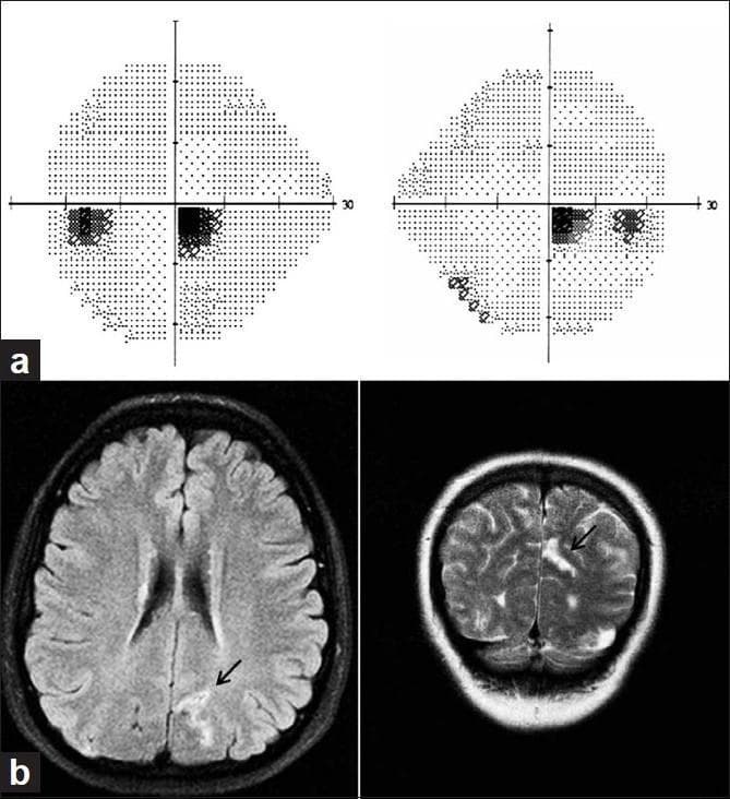 This composite educational image illustrates the correlation between clinical visual field testing and neuroimaging. Panel (a) displays a Standard Automated Perimetry (SAP) gray-scale plot showing a right inferior homonymous scotoma. The visual field defects are characterized by clusters of dark points primarily localized in the inferior-right quadrant of both eyes, signifying localized paracentral vision loss. Panel (b) contains two MRI brain scans: an axial FLAIR (Fluid-Attenuated Inversion Recovery) sequence on the left and a coronal T2-weighted sequence on the right. Both images feature an arrow pointing to a hyperintense lesion located in the superior bank of the left calcarine cortex (primary visual cortex). The visual field defect (inferior scotoma) correlates neuroanatomically with this superior bank lesion due to the retinotopic organization of the occipital lobe, where the superior calcarine cortex represents the inferior visual field. This material is designed for teaching neuro-ophthalmology and the localization of lesions along the visual pathway.