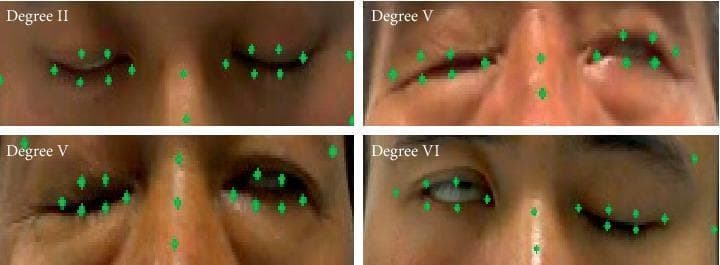 This set of clinical photographs illustrates various severities of facial paralysis, specifically focusing on the inability to close the eyes (lagophthalmos). The images are categorized by the House-Brackmann scale or similar facial nerve grading systems (FNGS 2.0). Degree II shows nearly complete eye closure with a minor slit remaining. Degree V (demonstrated in two panels) shows significant paresis with the eyelids remaining partially open, indicating severe dysfunction of the orbicularis oculi muscle. Degree VI shows total paralysis with a wide palpebral fissure and no voluntary movement. Green markers indicate the application of a facial landmark detection model (FP-FLDM) used to calculate the Eye Aspect Ratio (EAR). These markers trace the contours of the eyelids, medial and lateral canthi, and nasal bridge. The visual demonstrates the difficulty in automated landmark tracking in cases of severe facial asymmetry and pathological expressions. This material is relevant for neurology and ophthalmology education, focusing on cranial nerve VII assessment and the risk of corneal exposure.