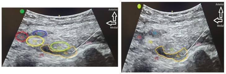 Diagnostic ultrasound images illustrating the Pericapsular Nerve Group (PENG) block for regional anesthesia. The composite contains two panels showing the cross-sectional anatomy of the anterior hip region. The left panel identifies key landmarks: the femoral artery (FA), femoral vein (FV), and femoral nerve (FN) located medially and superiorly. Deep to these lie the psoas tendon (PT), iliopubic eminence (IPE), and anterior inferior iliac spine (AIIS). The right panel demonstrates the clinical implementation of the block, where hypoechoic local anesthetic (AL) is seen spreading within the fascial plane between the psoas tendon and the underlying bony cortex (IPE and AIIS). The images highlight the anatomical plane containing sensory branches of the femoral, obturator, and accessory obturator nerves targeted for hip fracture analgesia. Orientation arrows indicate anterior and medial directions, emphasizing the deep approach required to reach the periarticular space while avoiding superficial neurovascular structures.