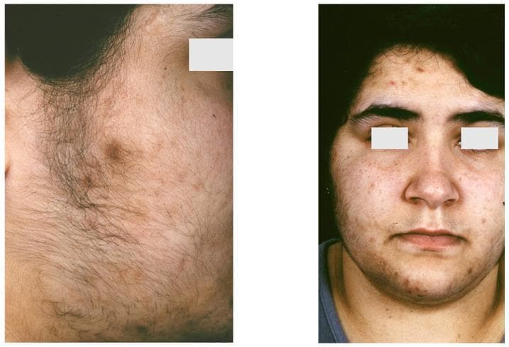 Clinical photograph of an 18-year-old female patient demonstrating the classic cutaneous triad of SAHA syndrome (HAIRAN variant): seborrhoea, acne, and hirsutism. The image consists of two panels: a close-up profile of the lower face and jawline (left) and a frontal view (right). The skin exhibits inflammatory acne vulgaris characterized by erythematous papules, pustules, and scattered comedones on the forehead, cheeks, and chin. Significant hirsutism is visible, featuring the growth of coarse, dark terminal hairs in a male-pattern distribution along the jawline, chin, and sideburn areas. Evidence of post-inflammatory hyperpigmentation and uneven skin texture suggestive of seborrhoea is also present. These findings are clinically associated with hyperandrogenism and insulin resistance, common in endocrine disorders such as Polycystic Ovary Syndrome (PCOS) or SAHA syndrome. The visual material is intended for medical education regarding the dermatological manifestations of endocrine dysfunction and androgen excess in female patients.