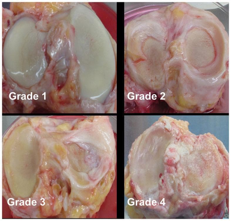 This clinical photograph displays four panels of human donor knee joint specimens illustrating the progressive stages of cartilage degeneration using the modified Collins grading system (Grades 1–4). Grade 1 shows relatively smooth articular surfaces with minor fibrillations. Grade 2 demonstrates more pronounced fibrillation and visible fissuring of the cartilage surface. Grade 3 displays significant cartilage erosion covering up to 30% of the surface, exposing subchondral bone, accompanied by the formation of osteophytes. Grade 4 represents severe osteoarthritis with over 30% of the cartilage surface eroded, extensive exposure of subchondral bone, gross geometric bony remodeling, and prominent osteophyte formation. The specimens highlight key pathological features of osteoarthritis, including loss of cartilage integrity, subchondral bone exposure, and secondary bony changes in the knee joint. This image serves as a reference for orthopedic pathology and gross morphological assessment of joint disease severity.