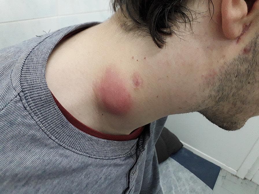 Clinical photograph of a patient's neck and jawline showcasing significant cervical lymphadenopathy. The primary finding is a large, erythematous, and edematous localized swelling in the lateral neck region, consistent with inflamed lymph nodes. The overlying skin exhibits intense redness and a shiny texture, suggesting acute inflammation or cellulitis. Additional smaller, erythematous papules and lesions are visible near the jawline and upper neck. This presentation is clinically associated with Immune Reconstitution Inflammatory Syndrome (IRIS) in the context of tuberculosis and co-infection with Bartonella henselae. The image illustrates the dermatological and lymphatic manifestations of opportunistic infections in immunocompromised patients, specifically highlighting the inflammatory response seen during immune recovery.