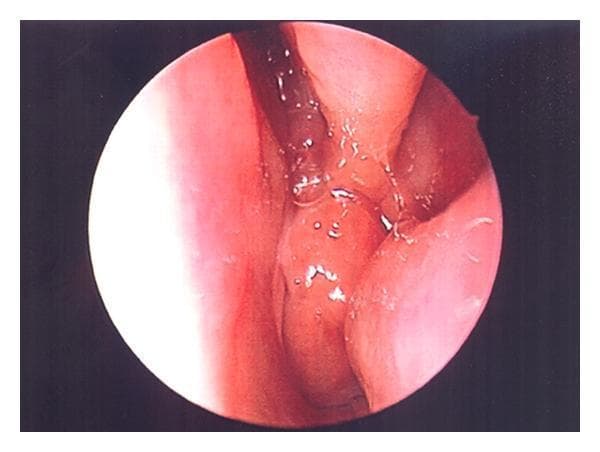 This diagnostic image is a clinical photograph captured via nasal endoscopy using a 2.7 mm zero-degree rigid scope. The view shows the nasopharynx where there is significant adenoid hypertrophy. The adenoid tissue appears as an enlarged, fleshy, pinkish-red mass with a lobular and irregular surface texture. The hypertrophied tissue occupies a substantial portion of the nasal airway, demonstrating clinical signs of obstruction. Notable surface features include scattered clear fluid droplets (likely seromucous secretions) and small streaks of vascular congestion or blood. The primary educational focus is to illustrate the endoscopic presentation of enlarged adenoids (adenoid vegetation) in the posterior nasal cavity, a common finding in pediatric patients with obstructive sleep apnea or chronic rhinosinusitis. Key landmarks include the surrounding nasal mucosa and the encroaching lymphoid tissue near the choana.