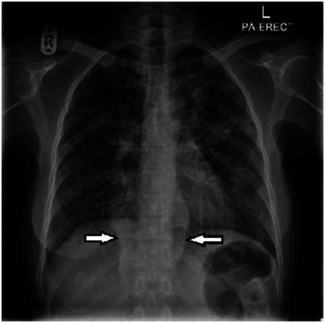 This posteroanterior (PA) erect chest radiograph demonstrates diffuse, bilateral pulmonary opacities and paraspinal soft tissue abnormalities. The lung fields exhibit extensive, small, nodular opacities ranging from discrete 'miliary' patterns to larger confluent areas, characteristic of hematogenous dissemination. In the lower thoracic region, bilateral homogeneous hyperdense shadows are visible adjacent to the spine (indicated by white arrows), suggesting paraspinal abscesses or collections. These findings are clinically significant for disseminated tuberculosis, presenting as miliary TB with associated Pott's disease (spondylodiscitis) and paraspinal involvement. The image illustrates key diagnostic markers for advanced mycobacterial infection, highlighting the relationship between parenchymal lung disease and extrapulmonary spinal manifestations.