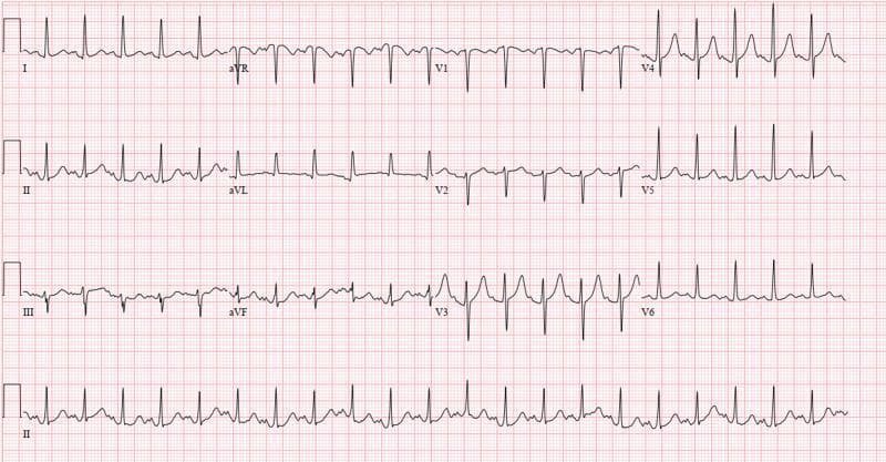 A 12-lead electrocardiogram (ECG) recorded on standard grid paper, demonstrating sinus tachycardia with a heart rate exceeding 100 bpm. The rhythm is regular with consistent R-R intervals and identifiable P waves preceding every QRS complex. The axis appears normal. In the precordial leads (V1-V6), there is a normal, albeit slightly rapid, R-wave progression from V1 to V4, with high-amplitude QRS complexes noted in V4 and V5, followed by a mild decrease in amplitude in V6. No significant ST-segment elevation, depression, or T-wave inversions are evident across the limb or precordial leads, suggesting the absence of acute ischemia. The rhythm strip at the bottom (Lead II) confirms a stable, tachycardic sinus rhythm. This ECG is clinically relevant for monitoring patients with acute systemic illnesses, such as COVID-19 or metabolic derangements, where sinus tachycardia is a common physiological response.