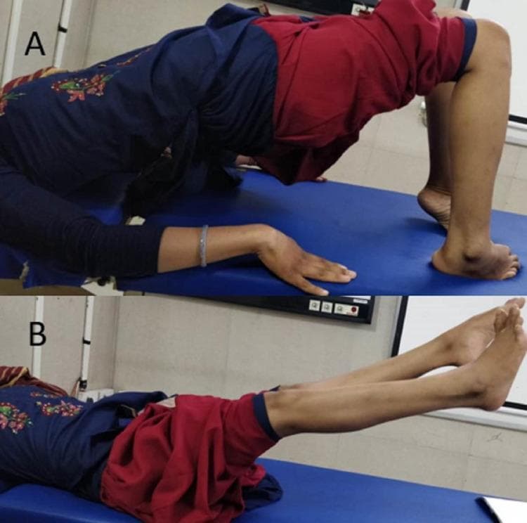Clinical photographs demonstrating the assessment of motor function and lower limb power in a patient one year post-spinal surgery. Image A shows the patient performing a supine bridge exercise, with the hips and torso elevated off the examination table. The posture demonstrates antigravity muscle strength in the hip extensors, supported by bent knees and feet flat on the table. Image B depicts the patient lying supine while performing a straight-leg raise or maintaining leg elevation against gravity, demonstrating power in the hip flexors and knee extensors. The images serve as a clinical follow-up to document neurological recovery after surgical decompression for a spinal epidural mass. The clinical context indicates improvement in hip and ankle motor power (graded 4/5) and knee extension (4/5), sufficient for ambulation with assistive devices despite residual ankle dorsiflexion weakness and spasticity.