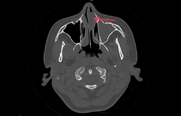 This diagnostic image is a non-contrast axial CT scan of the paranasal sinuses at the level of the maxillary antrum. The scan reveals a large, well-defined soft tissue density mass (indicated by a red arrow) within the left nasal cavity, characteristic of an antrochoanal polyp. This polypoidal lesion originates from the left maxillary sinus, which demonstrates complete opacification and widening of the maxillary ostium. There is evidence of mild bony remodeling of the left maxillary sinus walls. The mass extends anteriorly, causing significant obstruction of the left nasal passage and lateral displacement of the left inferior turbinate. Secondary findings include a marked diffuse deviation of the nasal septum toward the right side and compensatory hypertrophy of the right inferior turbinate. In contrast, the right maxillary sinus is well-aerated with normal mucosal thickness and clear ostiomeatal complex structures. This image serves as a clinical example of sinonasal polyposis and mechanical obstruction of the nasal airway, relevant for otolaryngology and radiology education.