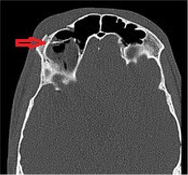 This diagnostic image is an axial non-contrast computerized tomography (CT) scan of the facial bones, utilizing a bone window setting to evaluate traumatic injury. The primary finding is a comminuted and displaced fracture of the right supraorbital rim and the anterior wall of the right frontal sinus, indicated by a red arrow. The fracture disrupts the normal cortical continuity of the bone, with posterior displacement of bony fragments into the sinus cavity. There is associated soft tissue swelling overlying the right supraorbital region. Intracranial air pockets, or pneumocephaly, are visible as hypodense (black) areas within the frontal sinus and extending toward the cranial cavity, suggesting a communication between the sinus and the intracranial space. This image demonstrates key radiological signs of maxillofacial trauma, specifically highlighting the risk of pneumocephaly following frontal sinus wall disruption. It is used in emergency medicine and neurosurgery to assess the severity of skull base or facial fractures and to screen for associated intracranial complications.