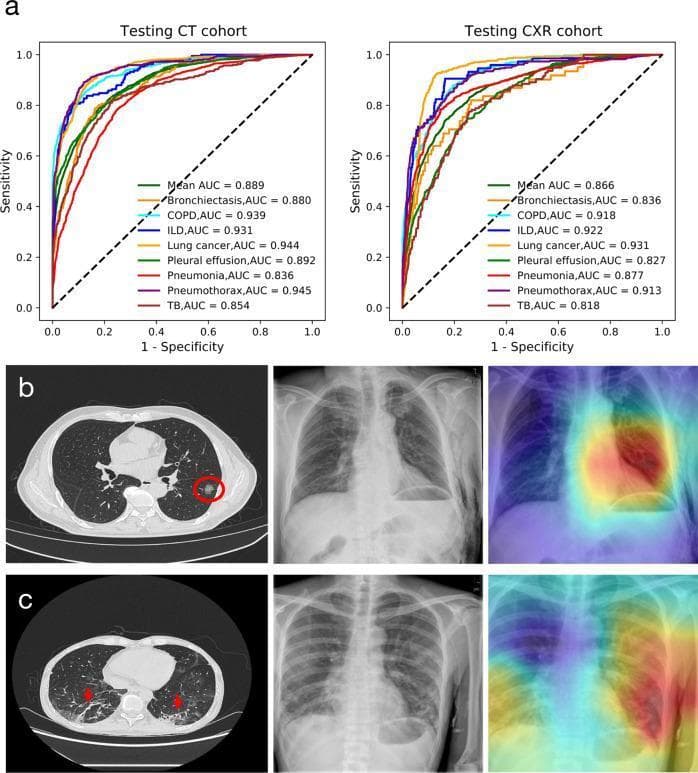 This composite image evaluates AI performance in respiratory disease diagnosis using CT scans and Chest X-rays (CXR). Section (a) presents two ROC curves comparing diagnostic accuracy for eight conditions: bronchiectasis, COPD, ILD, lung cancer, pleural effusion, pneumonia, pneumothorax, and tuberculosis. The CT cohort shows a slightly higher mean AUC (0.889) compared to the CXR cohort (0.866). Section (b) demonstrates a case of lung cancer. The axial CT slice shows a hyperdense pulmonary nodule in the right lung (highlighted with a red circle), while the corresponding CXR and AI heatmap show the system's ability to localize the lesion. Section (c) illustrates pneumonia; the axial CT scan displays bilateral patchy infiltrates and ground-glass opacities (indicated by red arrows) in the lower lobes. The accompanying CXR and heatmap visualize the infectious consolidation. This comparison highlights the superior sensitivity of CT for detecting subtle lesions, such as early-stage lung cancer and localized infectious shadows, compared to standard radiography, and demonstrates the utility of AI heatmaps in clinical localization.