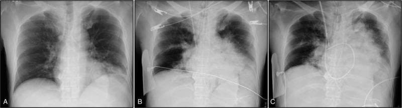 This series of three anterior-posterior (AP) chest X-rays (A, B, and C) illustrates a rapid progression of pulmonary consolidation over a 11-hour period. Image A shows an initial focal consolidation in the left lower lobe. Image B, taken 9 hours post-admission, demonstrates a marked increase in the density and volume of the left-sided infiltrate, characterized by the classic 'bulging fissure sign' where the consolidation expands to displace the interlobar fissure. Additionally, new patchy infiltrates are visible in the right lung. Image C, taken at 11 hours, shows near-complete opacification of the left hemithorax and worsening multifocal consolidation in the right lung. External medical hardware, including ECG leads and an endotracheal tube, are visible in the later images, reflecting clinical deterioration. This radiographic progression is highly suggestive of a fulminant necrotizing pneumonia, such as that caused by hypervirulent Klebsiella pneumoniae. The educational focus is on identifying rapid alveolar filling patterns and the radiographic signs of invasive pulmonary infections.