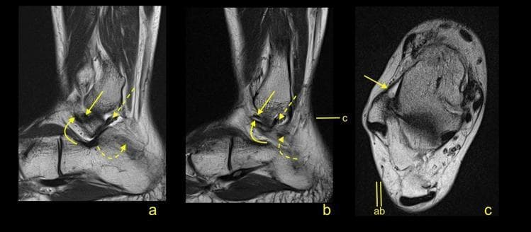 Magnetic Resonance Imaging (MRI) of the ankle joint in a 45-year-old patient, displaying sagittal (a, b) and transverse (c) sections. The images focus on the anatomy of the lateral collateral ligament complex. The sagittal views demonstrate a double-fascicular anterior talofibular ligament (ATFL), characterized by two distinct bundles of approximately equal diameter: the superior fascicle (S-ATFL, indicated by a straight yellow arrow) and the inferior fascicle (I-ATFL, indicated by a curved yellow arrow). The posterior talofibular ligament (PTFL) is visible as a hypointense band marked by a straight dashed arrow, while the calcaneofibular ligament (CFL) is denoted by a curved dashed arrow. In the transverse section (c), the orientation of the ATFL (arrow) relative to the lateral malleolus and talus is shown. These images are used to illustrate normal anatomical variants of the ankle ligaments, specifically the bifid or double-fascicular appearance of the ATFL, which is relevant for accurate diagnostic interpretation of ankle sprains and ligamentous stability.