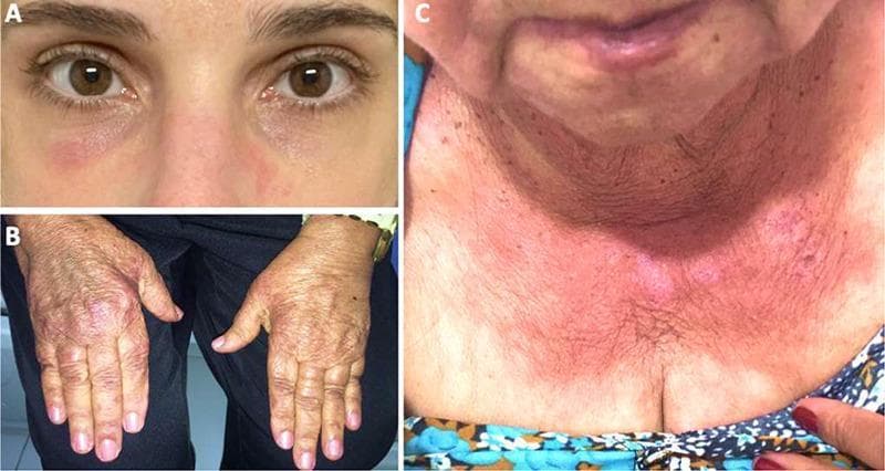 A composite of three clinical photographs demonstrating the classic cutaneous manifestations of dermatomyositis, an idiopathic inflammatory myopathy. Panel A: A heliotrope rash characterized by a reddish-purple (violaceous) discoloration in the periorbital region, involving the eyelids and malar area. Panel B: Gottron papules/sign, presenting as erythematous to violaceous, slightly scaly patches overlying the dorsal aspect of the metacarpophalangeal and interphalangeal joints. Panel C: The 'V-sign,' a confluent erythematous rash in a photosensitive distribution across the anterior lower neck and upper chest. These findings are pathognomonic for dermatomyositis and are critical for clinical diagnosis, often preceding or accompanying proximal muscle weakness. The images highlight key dermatologic markers used to differentiate dermatomyositis from other connective tissue diseases and inflammatory myopathies like polymyositis.