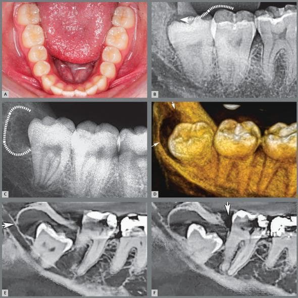A multi-panel educational composite illustrating the pathophysiology of pericoronitis and paradental cyst formation associated with mandibular third molars. Panel A shows a clinical photograph of a partially erupted third molar with a distal gingival operculum. Panel B (periapical radiograph) uses a dotted arrow to demonstrate the pathway for microbial biofilm infiltration between the crown and the pericoronal follicle. Panel C illustrates irregular distal bone resorption (highlighted by a dotted line) resulting from chronic inflammatory episodes. Panel D provides a 3D reconstructed CT view showing the resulting bone defect and communication with the oral cavity. Panels E and F are sagittal CT slices demonstrating a well-defined radiolucency distal to the third molar crown, characteristic of a paradental cyst. Key educational concepts include the progression from operculum-mediated bacterial stagnation to acute/chronic pericoronitis and secondary inflammatory cyst development in the mandibular ramus region.