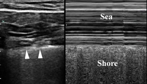 A split-field thoracic ultrasound image demonstrating normal lung findings in both B-mode (left) and M-mode (right). The left panel shows a 2-D grayscale view of the chest wall with alternating hyperechoic and hypoechoic layers representing subcutaneous tissue and muscle. A distinct, bright hyperechoic horizontal line (indicated by white arrowheads) represents the normal pleura. The right panel displays the M-mode 'seashore sign,' which confirms the presence of lung sliding and rules out pneumothorax at that site. The 'sea' portion (top) consists of horizontal, parallel linear echogenicities representing the stationary chest wall. Below the pleural line, the 'shore' (bottom) displays a granular, sandy texture representing the dynamic motion of the pulmonary parenchyma during respiration. This visual comparison is a fundamental component of the Extended Focused Assessment with Sonography for Trauma (eFAST) protocol used to evaluate for intra-pleural air or fluid.