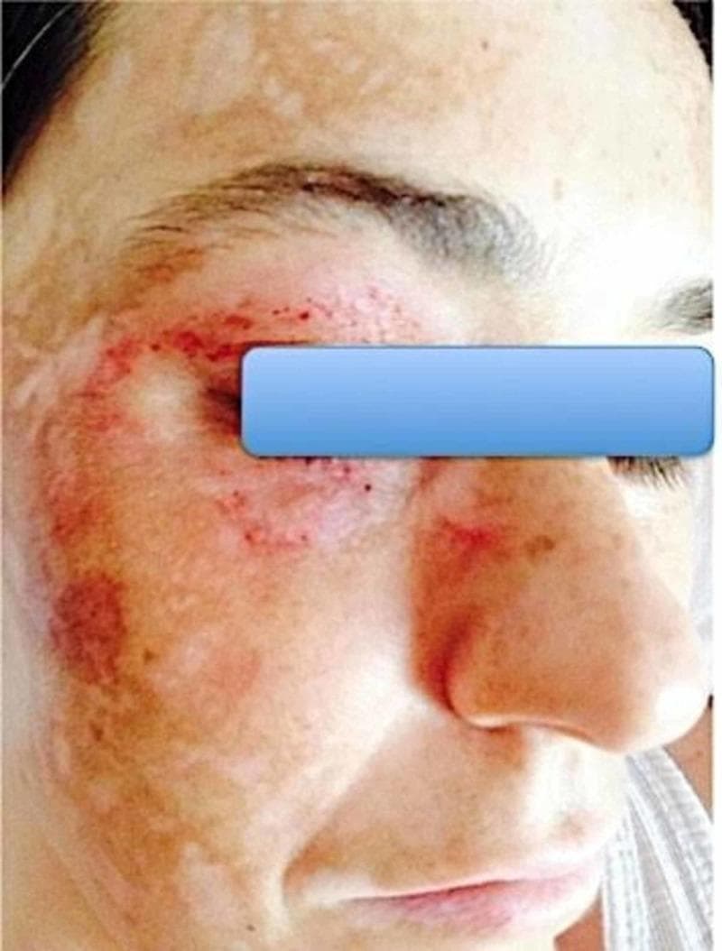 This clinical photograph shows a close-up frontal view of a patient's face, primarily focusing on the right side. The skin exhibits complex dermatological changes following stereotactic radiosurgery for trigeminal neuralgia. The lesions are localized in a distribution corresponding to the branches of the right trigeminal nerve (V1, V2, and V3). Morphological features include multiple erythematous, petechial-like punctate lesions and maculopapular eruptions around the orbital region and right cheek. Additionally, there are significant areas of dyschromia, characterized by large, irregular patches of hypopigmentation (leukoderma) interspersed with hyperpigmented macules, giving the skin a mottled appearance. The skin texture appears uneven with areas of thinning and possible scarring. This image demonstrates the dermatological manifestations of Trigeminal Trophic Syndrome (TTS), a rare complication where self-inflicted trauma or dysregulated sensory feedback leads to chronic skin lesions in the anesthetic distribution of the nerve. It serves as an educational example of the clinical relationship between neuropathic pain disorders and secondary cutaneous pathology.