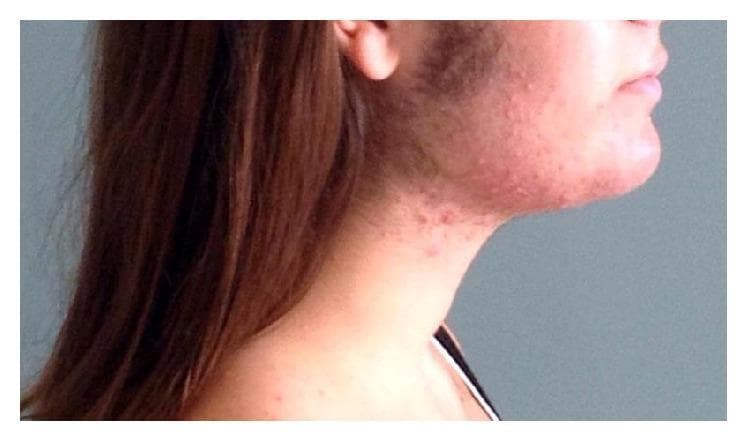 A clinical photograph of a female patient's face and neck in a lateral profile view, demonstrating clinical signs of hyperandrogenism and virilization. The image reveals prominent hirsutism, characterized by coarse, dark hair growth in an androgen-dependent distribution, specifically involving the preauricular (sideburn) area, cheeks, and along the mandibular jawline. Accompanying these findings is an inflammatory acneiform eruption, presenting as erythematous papules and pustules clustered around the jaw and upper neck. This combination of acne and hirsutism is highly suggestive of an underlying hyperandrogenic state. The educational focus of this image is the recognition of physical manifestations of excessive androgen levels in female patients, which may be associated with conditions such as polycystic ovary syndrome (PCOS) or, in this clinical context, pregnancy-related luteoma.