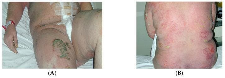 Clinical photographs of a postpartum patient presenting with Generalized Pustular Psoriasis (GPP), also known as von Zumbusch psoriasis. Image (A) shows the abdomen and upper thighs of a patient in a hospital setting, demonstrating diffuse, confluent erythema with scattered monomorphic pustules. A prominent area of dark, possibly necrotic or heavily crusting, irregular discoloration is visible on the anterior right thigh. Surgical dressings are present on the abdomen. Image (B) provides a detailed view of the patient's back, illustrating widespread, intense erythema. Numerous small, sterile, yellowish-white pustules are distributed across the back and flanks, some of which are coalescing into larger lakes of pus. The skin appears severely inflamed and irritated. These visuals demonstrate the acute inflammatory nature of GPP, a rare and severe form of psoriasis characterized by sudden eruptions of sterile pustules on a background of intense erythema, often associated with systemic symptoms and triggered in some cases by the postpartum period.
