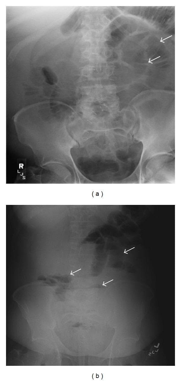 This composite diagnostic image features two abdominal radiographs (X-rays) of a single patient, illustrating classic signs of a distal small bowel obstruction. Image (a) is a supine abdominal radiograph demonstrating multiple dilated loops of small bowel in the central abdomen, characterized by thin transverse lines (valvulae conniventes). Notably, there is a paucity or near-total absence of gas within the large bowel, suggesting a complete or high-grade distal obstruction. Image (b) is an upright (erect) abdominal radiograph of the same patient, which reveals several prominent air-fluid levels (indicated by white arrows) within the dilated proximal and central small bowel loops. These tiered horizontal interfaces are a hallmark radiological finding of mechanical intestinal obstruction. The combination of dilated small bowel loops and multiple air-fluid levels, in the absence of significant colonic gas, is highly indicative of a distal small bowel obstruction, which in this clinical context was secondary to ileocolic intussusception.