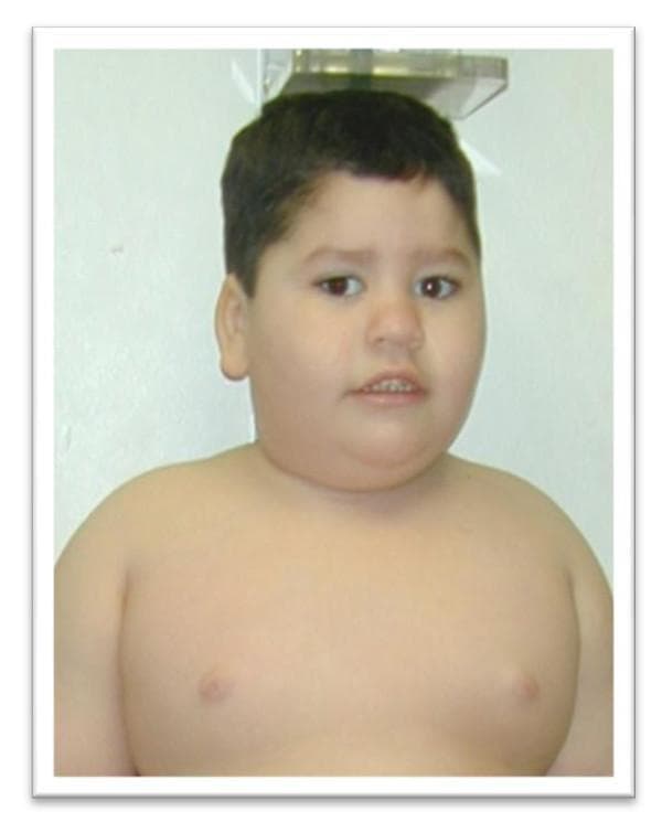 A clinical photograph of a young child illustrating the characteristic physical phenotype of Prader-Willi Syndrome (PWS). The image displays typical facial dysmorphism, including almond-shaped eyes, a narrow bifrontal diameter, and a downturned angle of the mouth with a thin upper lip. The subject exhibits a round facial contour and a notably short neck. Below the head, the photograph demonstrates a morbidly obese body habitus, characterized by excess adipose tissue distribution in the trunk and chest areas. This visual serves as an educational reference for the diagnostic clinical features of PWS in the pediatric population, emphasizing the transition from neonatal hypotonia to the childhood phase of hyperphagia and subsequent obesity. Key concepts shown include genetic syndrome recognition and characteristic craniofacial morphology.