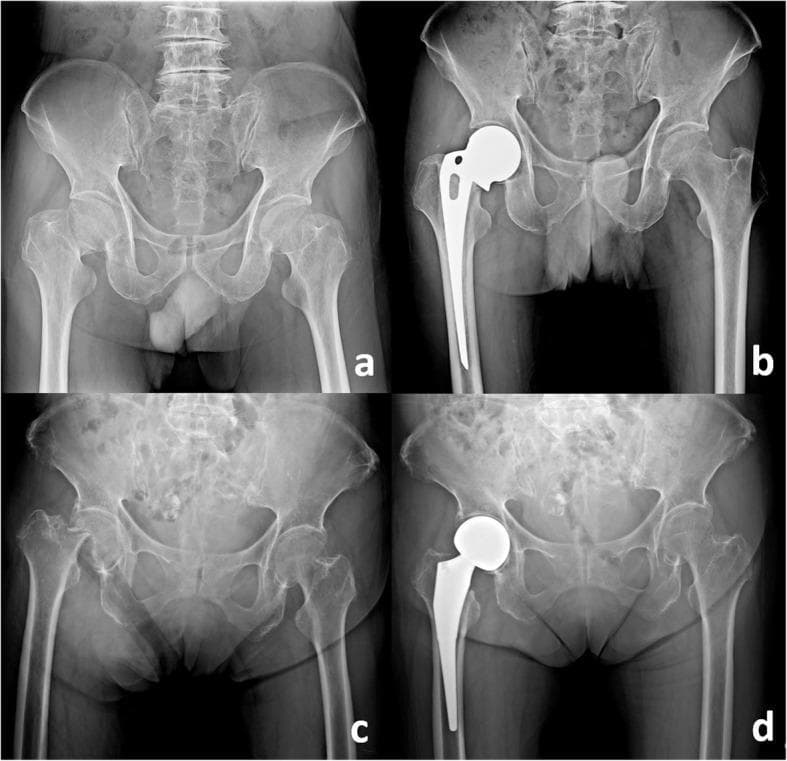 This composite of four anteroposterior (AP) pelvic radiographs illustrates acute femoral neck fractures and their subsequent management with hip hemiarthroplasty. Panels 'a' and 'c' demonstrate displaced fractures of the right femoral neck. Key features include cortical discontinuity, superior migration and external rotation of the femoral shaft, and disruption of Shenton’s line, indicating a total loss of alignment between the femoral head and the acetabulum. Panels 'b' and 'd' show the postoperative results of different hemiarthroplasty techniques for managing these fractures. Panel 'b' depicts a unipolar monoblock prosthesis (Austin-Moore type) characterized by a solid, single-component femoral stem and head fixed within the femur. Panel 'd' shows a bipolar hemiarthroplasty, featuring a modular femoral stem and a dual-mobility head designed to articulate both with the acetabulum and at a secondary internal joint. These images serve as educational examples for orthopedic radiology, highlighting the classification of intracapsular hip fractures and the selection of prosthetic implants based on patient needs and surgical protocol.