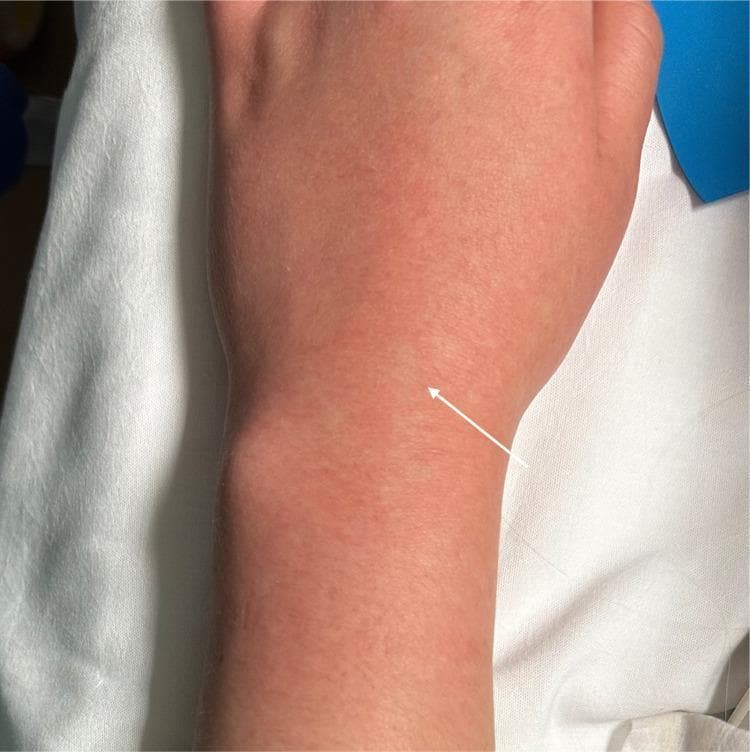 This clinical photograph displays a maculopapular rash on the dorsal surface of the human upper extremity, extending from the wrist to the distal forearm. The dermatological presentation is characterized by widespread, confluent erythema that gives the skin a deep reddish-pink appearance. A distinctive feature is the presence of several small, pale, well-demarcated patches of unaffected skin within the larger erythematous area, commonly referred to as 'islands of white in a sea of red.' An arrow indicates one such spared island on the wrist. The skin texture appears relatively smooth without prominent scaling, vesicles, or ulceration. This specific visual pattern is a classic clinical finding often associated with the recovery phase of Dengue fever or other viral exanthems. The image illustrates key diagnostic signs for infectious disease evaluation, emphasizing distribution patterns and characteristic skin sparing.