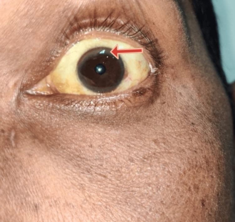 A close-up clinical photograph of a left eye and periorbital region demonstrating characteristic signs of hepatolenticular degeneration (Wilson disease). The sclera exhibits marked icterus (yellowish discoloration), consistent with hyperbilirubinemia or underlying chronic liver disease. At the peripheral margin of the cornea, a brownish-yellow Kayser-Fleischer (KF) ring is visible, particularly highlighted by a red arrow in the superior-temporal quadrant. This ring represents copper deposition in Descemet's membrane. The iris is dark brown, and the surrounding skin shows a slightly uneven pigmentation. The image serves as an educational example of ophthalmologic manifestations associated with systemic metabolic disorders and copper metabolism dysfunction.