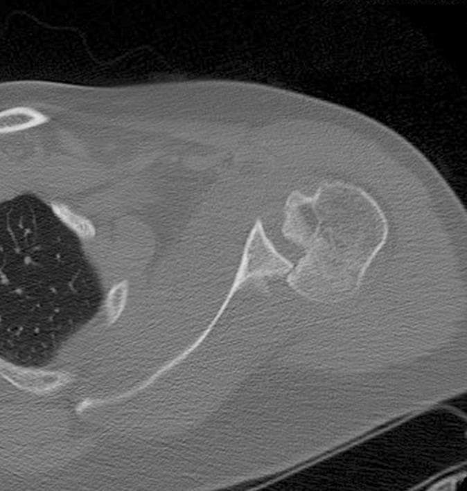 This diagnostic image is an axial Computed Tomography (CT) scan of the right shoulder, illustrating a posterior locked fracture-dislocation. The key visible pathology is a significant impaction fracture on the anterior-medial aspect of the humeral head, clinically identified as a reverse Hill-Sachs lesion (or McLaughlin lesion). The humeral head is displaced posteriorly relative to the glenoid fossa, resulting in an articular incongruity where the humeral head is 'locked' behind the posterior glenoid rim. The CT scan demonstrates the disruption of the normal rounded contour of the humeral head, showing an approximately 35-40% articular surface defect. The scapular spine and the glenoid fossa are visible, with the latter appearing relatively intact. This finding is a classic orthopedic manifestation of a posterior shoulder dislocation, often occurring as a complication of high-energy trauma or seizures. The image serves as an educational tool for identifying humeral head defects and assessing glenohumeral alignment in orthopedic radiology.