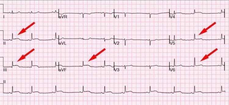 A 12-lead electrocardiogram (ECG) demonstrating abnormalities in a patient with cardiovascular collapse. The tracing shows a sinus rhythm with key pathological features highlighted by red arrows. Notable findings include significant ST-segment elevation in the inferior leads (II, III, and aVF) and lateral leads (V5, V6), indicating an inferolateral ST-elevation myocardial infarction (STEMI) pattern or acute pericardial involvement. Additionally, there is evidence of poor R-wave progression across the precordial leads (V1 through V6), where the expected increase in R-wave amplitude is absent. These visual findings correlate clinically with cardiac tamponade or myocardial injury. The image serves as an educational example of identifying acute ischemic or inflammatory patterns on ECG and recognizing poor R-wave progression as a sign of underlying pathology or loss of viable myocardium.