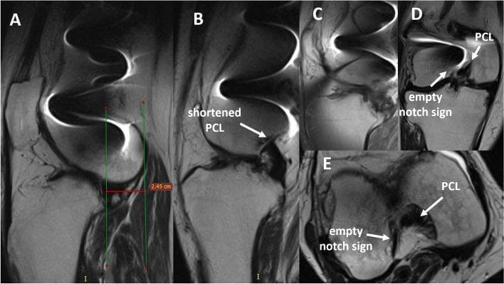 This composite diagnostic image presents multiple MRI views (sagittal, coronal, and axial) of a human knee joint, illustrating chronic ligamentous injury and joint malalignment. A: Sagittal view demonstrating significant anterior tibial subluxation, where the proximal tibia is displaced anteriorly relative to the femoral condyles, measured at approximately 2.45 cm. B: Sagittal view showing a shortened and thickened posterior cruciate ligament (PCL). B, C, D: Sequential sagittal and coronal slices highlight the complete absence of visible anterior cruciate ligament (ACL) fibers. D, E: Coronal and axial views specifically demonstrate the 'empty notch sign' within the femoral intercondylar notch, a classic radiological indicator of a complete ACL tear or chronic ACL deficiency. The imaging collectively illustrates fixed anterior tibial knee subluxation associated with combined ACL and PCL pathology, likely resulting from high-energy trauma or chronic instability. These findings are critical for preoperative planning in complex ligamentous reconstructions or quadricepsplasty procedures.