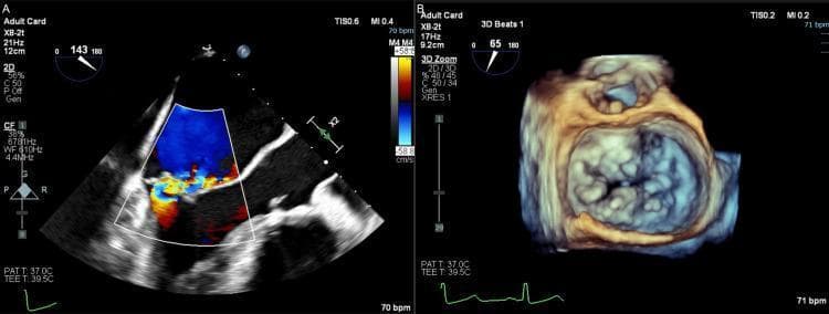 Preoperative transesophageal echocardiography (TEE) images demonstrating severe mitral valve regurgitation in a patient with Barlow’s disease. Panel A is a 2D TEE with color Doppler overlay showing a large blue-colored jet within the left atrium, indicating blood flow moving away from the transducer, with a high-velocity, turbulent mosaic of red and yellow at the valvular orifice representing significant regurgitant flow. Panel B is a 3D volume-rendered TEE reconstruction of the mitral valve from the surgical atrial perspective ('surgeon's view'). This image depicts the complex anatomy of the mitral valve leaflets, characterized by irregular surface texture, excessive tissue, and multiple bulging segments consistent with bileaflet prolapse and a flail posterior leaflet (P2/P3 segments). The anatomical visualization highlights severe left atrial enlargement and the distinctive bulky, thickened morphology associated with myxomatous degeneration of the mitral valve apparatus.