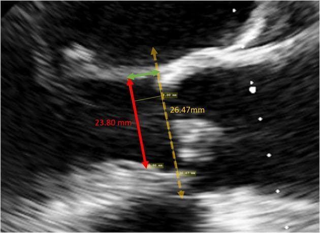 A mid-esophageal long-axis view obtained via Transesophageal Echocardiography (TEE) showing preoperative measurements of the Left Ventricular Outflow Tract (LVOT). The diagnostic image demonstrates critical cardiac anatomy for surgical planning, including the interventricular septum, aortic valve region, and the anterior mitral leaflet. Three distinct measurement lines are annotated: a dashed yellow line (26.47 mm) representing the aortic annulus diameter; a solid red line (23.80 mm) measuring the LVOT diameter at the theoretical landing site; and a horizontal green arrow indicating an 8.00 mm distance apical to the annulus to define that landing site. This imagery is essential for determining valve sizing and the degree of over-sizing required for sub-annular stent placement. The echogenicity highlights the boundaries of the septal endocardium and the valvular apparatus, providing a reference for cardiac anesthesiologists and surgeons during transcatheter or surgical aortic valve replacement evaluations.