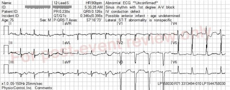 A 12-lead electrocardiogram (ECG) showing a sinus rhythm with a prolonged PR interval (238 ms) and a wide QRS complex (126 ms), characteristic of a first-degree atrioventricular (AV) block and an intraventricular conduction delay or borderline left bundle branch block (LBBB). In the limb leads (I, II, III, aVR, aVL, aVF), the P waves are upright in the inferior leads and inverted in aVR. The precordial leads (V1-V6) demonstrate deep S-waves in V1-V3 and tall R-waves in V4-V6, typical of LBBB morphology. There is noticeable ST-segment depression and T-wave flattening in leads V1-V3, while leads V4-V6 show more prominent upright T-waves and slight ST-elevation. This image represents the post-treatment state following calcium chloride administration for hyperkalemia, illustrating the narrowing of the QRS complex and stabilization of the cardiac membrane compared to earlier findings. Key educational concepts include ECG recognition of electrolyte imbalances, conduction abnormalities, and the therapeutic effect of calcium in emergency medicine.